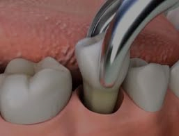 dental crowns clarence ny