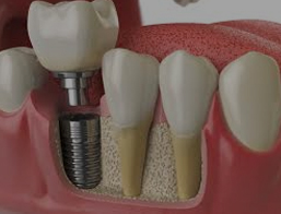 dental implants clarence ny